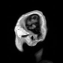 MRI parasagital...